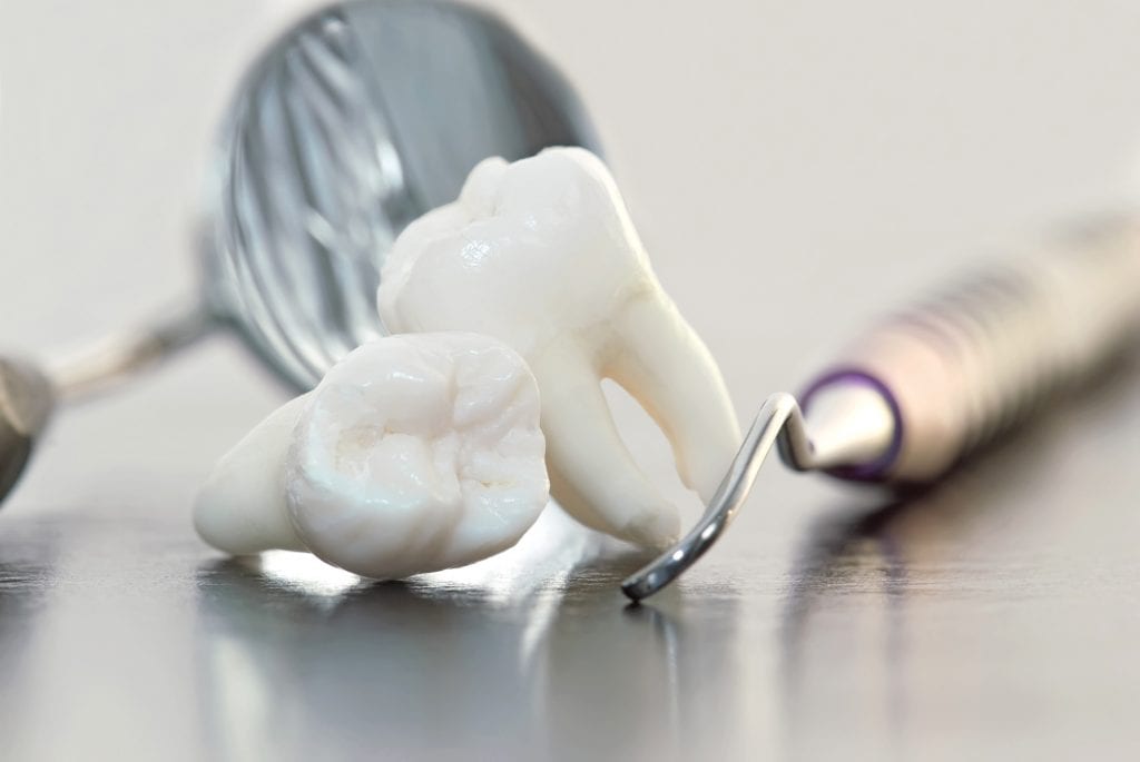 Wisdom Teeth Removal